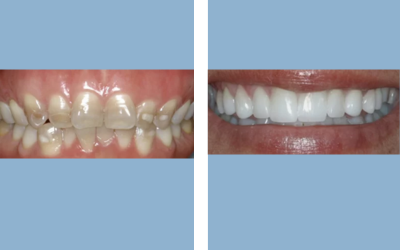 Before and After